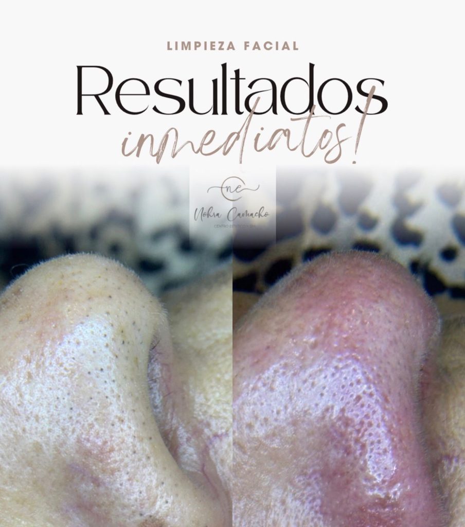 Antes y después de tratamientos faciales profesionales